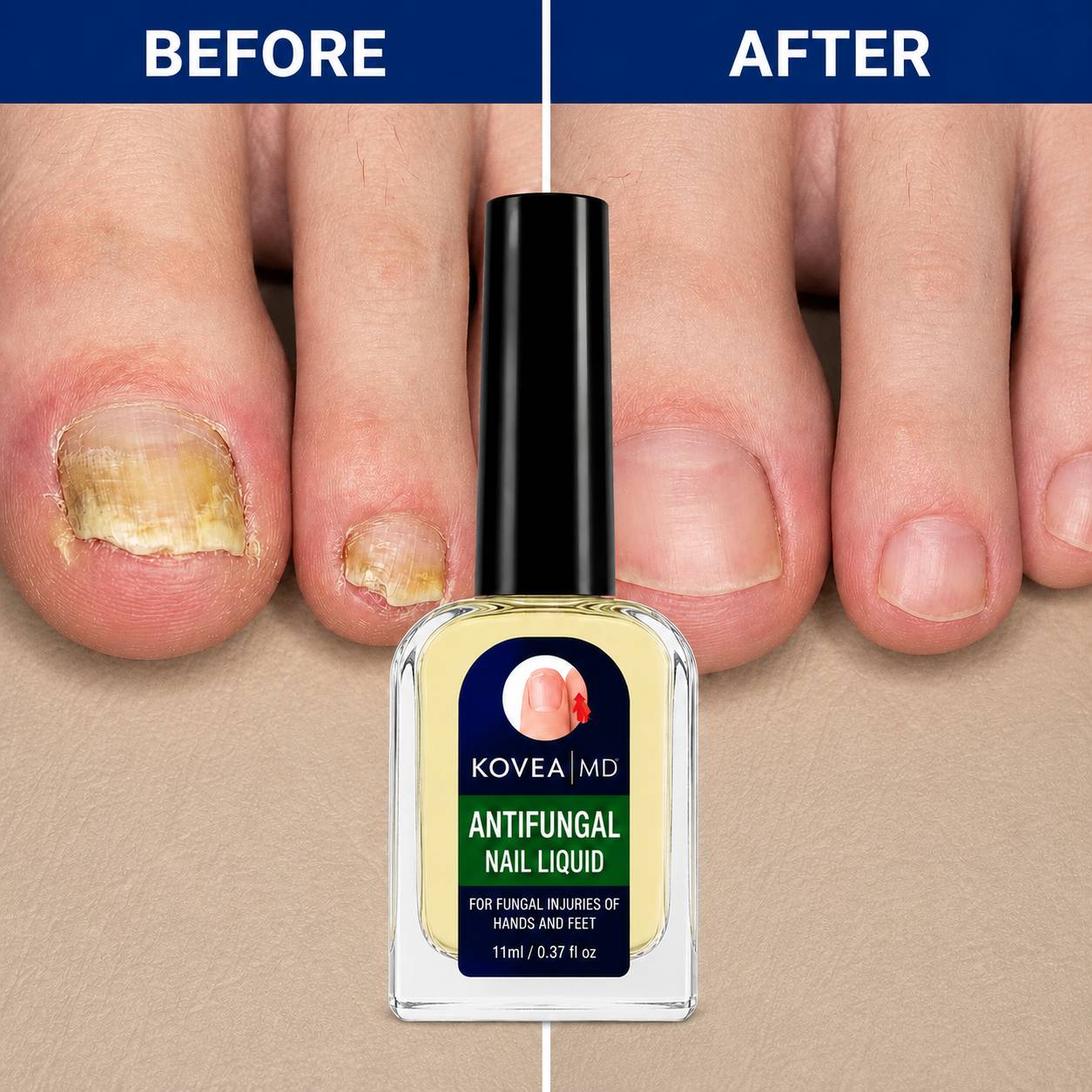 Clear Fungus Nails & Restore Healthy Clear Nails in Just 14 Days!